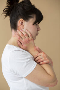 Psoriasis treatment
