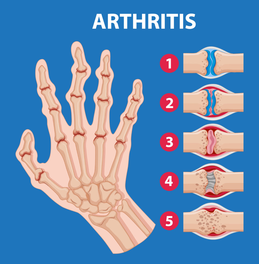 arthritis treatment in hyderabad