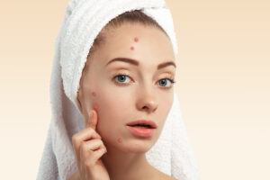 pimples treatment in hyderabad